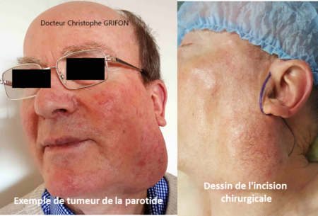 Chirurgie Orl Glandes Salivaires Docteur Christophe Grifon